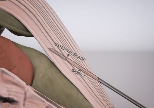 3D medical illustration showing the external blade and biopsy needle positioned between anatomical tissue layers during a surgical procedure