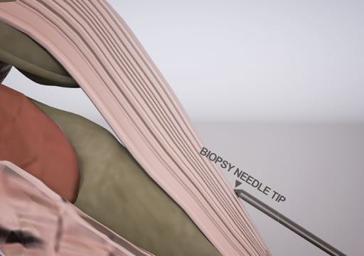 3D medical illustration showing a biopsy needle tip being inserted into layered anatomical tissue during a surgical procedure