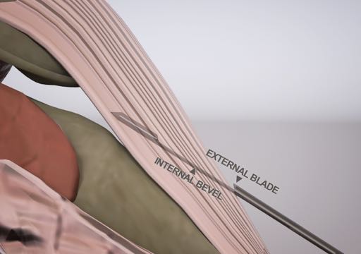 3D medical illustration showing the external blade and internal bevel of a surgical instrument being inserted between anatomical tissue layers