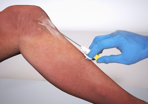 3D medical illustration showing a gloved surgeon applying the Striate+ collagen tendon repair device onto a patient's forearm using a yellow surgical applicator