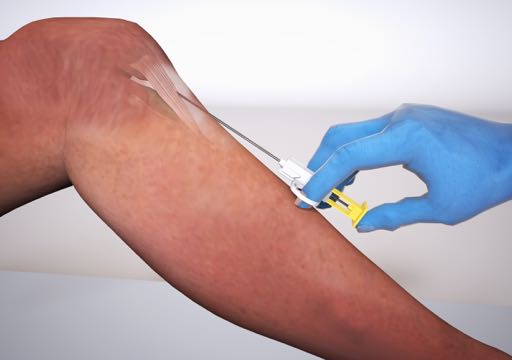 3D medical illustration showing a surgeon in blue gloves applying the Striate+ collagen tendon repair device to a patient's arm using a surgical delivery tool